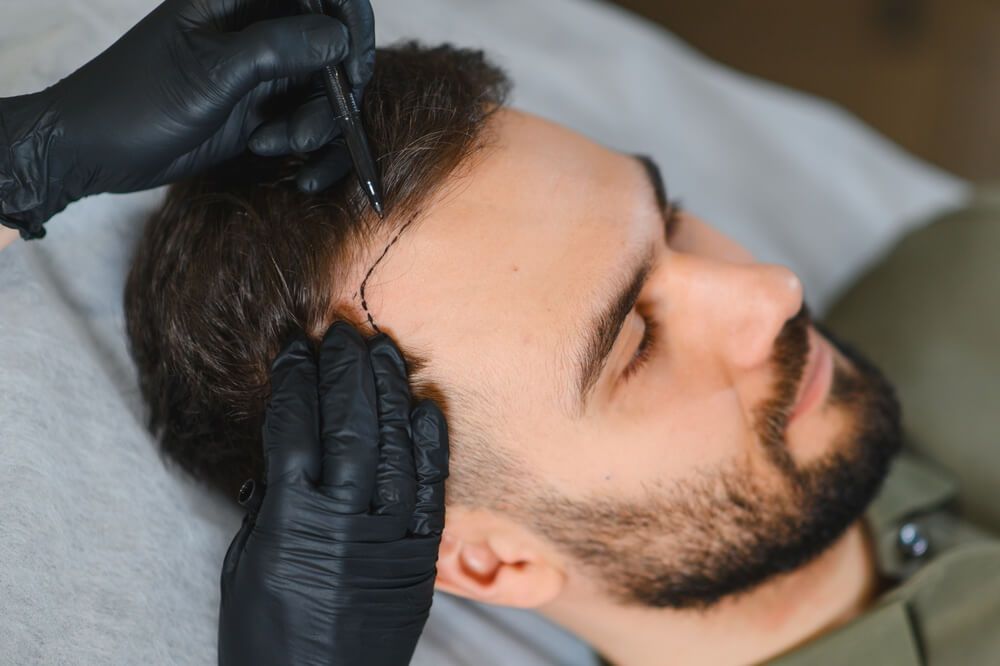 hair restoration on man